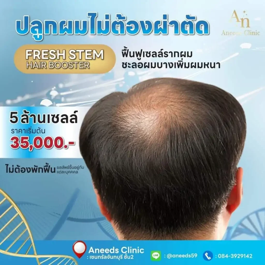 ปลูกผมไม่ต้องผ่าตัดด้วย Fresh Stem Hair Booster บอกลาปัญหาผมบาง ผมร่วง ด้วยเทคนิคสุดล้ำ ฟื้นฟูเซลล์รากผม ที่ช่วยกระตุ้นการเจริญเติบโตของเส้นผม เพิ่มความหนาอย่างเห็นผล