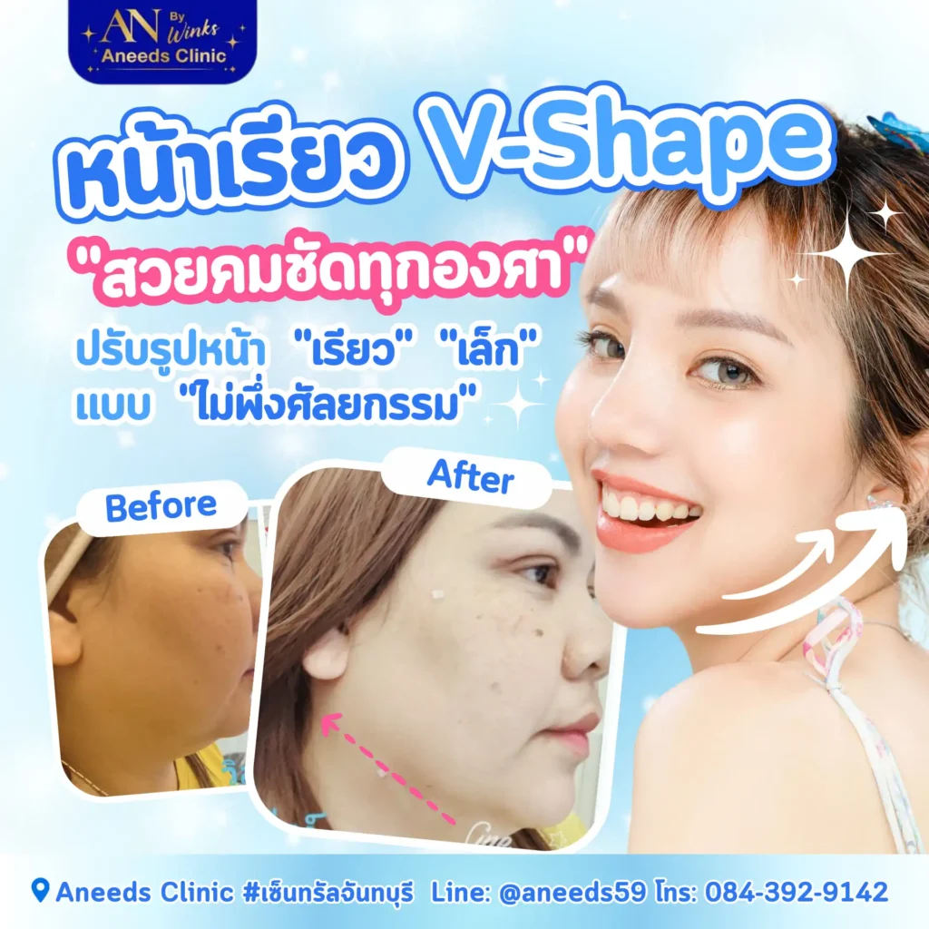 หน้าเรียว VShape ปรับรูปหน้าเรียว เล็ก